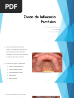 Zonas de Influencia Protésica