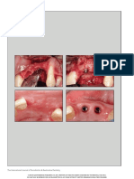 Urban - Evaluation of The Combination of Strip Gingival Grafts and A Xenogeneic Collagen Matrix For The Treatment of Severe Mucogingival Defects