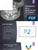 Prevención de Impactación de Caninos