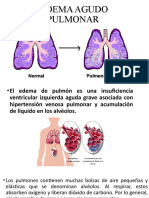 Edema Agudo Pulmonar