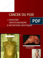 5 - Cancer Du Foie