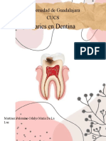 Caries en Dentina