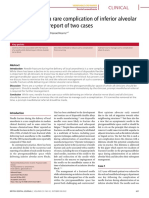 Broken Needle - A Rare Complication of Inferior Alveolar Nerve Block - A Report of Two Cases