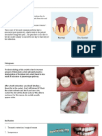 Dry Socket Presentation