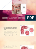 Colitis Ulcerosa Crónica Idiopática