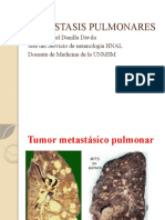 Metastasis Pulmonares