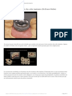 Algunos Detalles en Prótesis Fija Sobre Implantes (DR - Ernest Mallat)