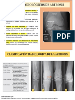 Signos Radiológicos de Artrosis