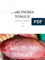 33) Carcinoma Tongue