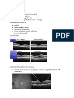 Clase 2 Interfase Vitreo Retinal