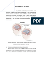 HIDROCEFALIA