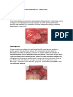 Tumores de Cavidad Oral (Boca, Lengua, Uvula)