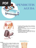 Apendicitis Aguda