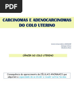 AULA 6 - Carcinomas e Adenocarcinomas Do Colo Uterino