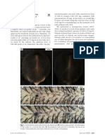 Very Low Dose Oral Minoxidil in Male Androgenetic