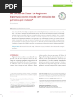 Má Oclusão de Classe I de Angle Com Biprotrusão Severa Tratada Com Extrações Dos Primeiros Pré-Molares