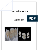 Incrustaciones ESTETICAS