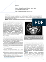 Endovascular Treatment of Duplicated Inferior Vena Cava Compression From Retroperitoneal Fibrosis