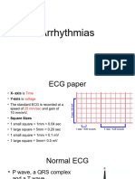 Arrhythmias