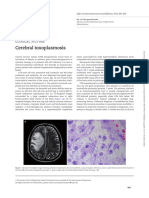 Cerebral Toxoplasmosis - 1