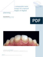 The Injectable Composite Resin Technique Biocopy of A Natural Tooth - Advantages of Digital Planning