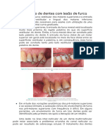 Tratamento de Dentes Com Lesão de Furca