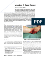 Total Talar Extrusion: A Case Report: Justin Fleming, DPM, and Kimberly K. Hurley, DPM