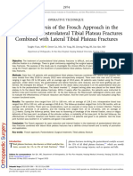 Clinical Analysis of The Frosch Approach in The Treatment of Posterolateral Tibial Plateau Fractures Combined With Lateral Tibial Plateau Fractures