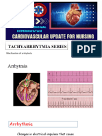 Mechanisme Arrhythmia