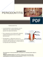 Periodontitis