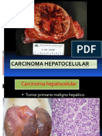 Carcinoma Hepatocelular