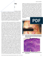 Brar (2007) - NS Resemples Lymphoreticular Process