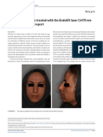 Static Glabellar Lines Treated With The Endolift Laser (1470 NM Diode Laser) : A Case Report