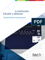 Extrasistolia Ventricular. Estudio y Ablación M4T10