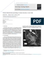 Uterine Adenosarcoma Presenting As Uterine Inversion A Case Study