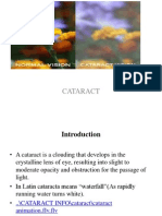 Cataract