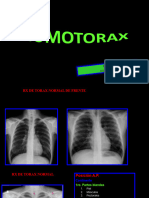 Segunda Clase Neumotorax Dx. Radiologico