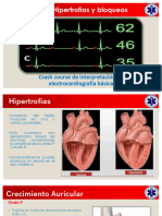 SOS EKG Basico 2 Hipertrofias y Bloqueos