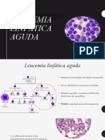 Leucemia Linfática Aguda