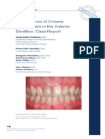 Co Existene of Crowns and Veneers