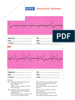 EKG Ventricular Rhythms