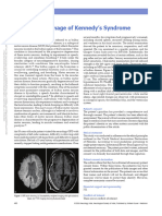 Rare Clinical Image of Kennedy S Syndrome.57