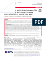 Iatrogenic Acute Aortic Dissection Caused by Intervention For Spontaneous Coronary Artery Dissection: A Surgical Case Report