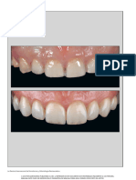 A Simplified Approach For Restoration of Worn Dentition Using The Full Mock-Up Concept - Clinical Case Reports - En.es