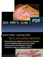 Dupuytrenscontracture 140504003149 Phpapp01