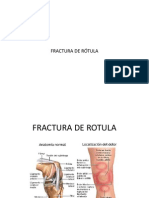 Fractura de Rotula