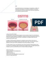 Infección en Vías Urinarias Bajas