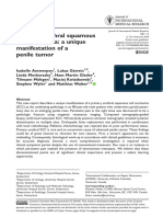 Primary Urethral Squamous Cell Carcinoma A Unique Manifestation of A Penile Tumor