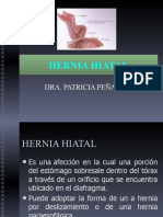 Hernia Hiatal