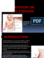 Pyloric Stenosis